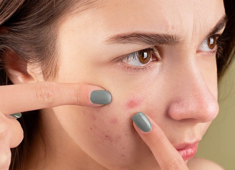 Woman Squeezing Her Pimples with Her Fingers